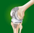 Prosthesis of the knee surgical Royalty Free Stock Photo