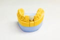 Prosthetic teeth. restoration of the front tooth. Dental laboratory