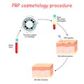 PRP cosmetology procedure. test tubes and syringe with blood and platelet-rich plasma