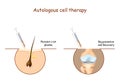 Prp. Platelet-rich plasma. Autologous cell therapy