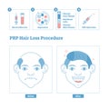 PRP Procedure, men`s beauty and health cosmetology scheme. Male baldness issues and solution. Royalty Free Stock Photo