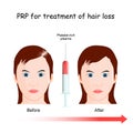 PRP procedure for treatment of hair loss