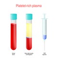 PRP. Two test tubes and syringe with blood and platelet-rich plasma