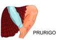 Pruritus, itching and skin lesions in a child