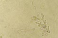 Pseudohyphae and budding yeast cells in patient urine Royalty Free Stock Photo