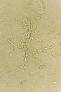 Pseudohyphae and budding yeast cells in patient urine Royalty Free Stock Photo