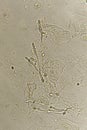 Pseudohyphae and budding yeast cells in urine Royalty Free Stock Photo