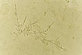 Pseudohyphae and budding yeast cells in urine Royalty Free Stock Photo