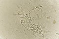 Pseudohyphae and budding yeast cells in patient urine Royalty Free Stock Photo