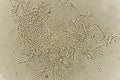 Pseudohyphae and budding yeast cells in patient urine Royalty Free Stock Photo