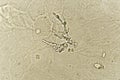 Pseudohyphae and budding yeast cells in patient urine