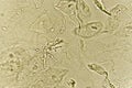 Pseudohyphae and budding yeast cells in patient urine Royalty Free Stock Photo