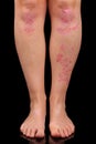 Psoriasis