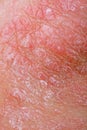 Psoriasis Royalty Free Stock Photo