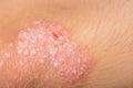 Psoriasis Royalty Free Stock Photo