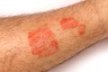 Psoriasis. Alergic rashes on the skin close up. The concept of t