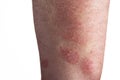 Psoriasis on the arm Royalty Free Stock Photo