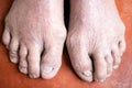 Psoriasis,Atopic dermatitis,dry skin of the toes,cracked skin of feet and disease of Onychomycosis,Tinea Unguium,toenail fungus