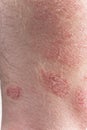 Psoriasis close-up Royalty Free Stock Photo