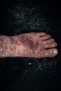 Psoriasis eczema on the foot Man itching skin Psoriasis scales are scattered on black background.