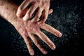 Psoriasis eczema on the hand Man itching skin Psoriasis scales are scattered on black background.