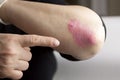 Psoriasis on elbow