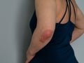 Psoriasis on elbow. Isolated. Closeup of rash and scaling on the patient`s skin. The concept of chronic disease treatment.