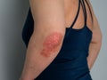 Psoriasis on elbow. Isolated. Closeup of rash and scaling on the patient`s skin. The concept of chronic disease treatment.