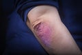 Psoriasis on elbow Royalty Free Stock Photo