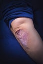 Psoriasis on elbow Royalty Free Stock Photo