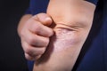 Psoriasis on elbow Royalty Free Stock Photo