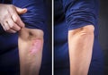Psoriasis on elbow before and after Royalty Free Stock Photo