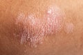 Psoriasis on elbow skin Royalty Free Stock Photo