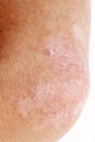 Psoriasis on elbow Royalty Free Stock Photo