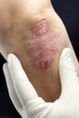 Psoriasis on elbows