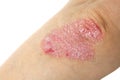 Psoriasis Royalty Free Stock Photo