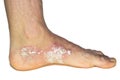 Psoriasis on the foot isolated