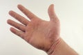 Exacerbation of psoriasis in the hands