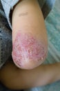 Psoriasis on kid's elbow