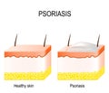 Psoriasis