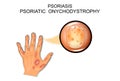 Psoriasis. psoriatic onychodystrophy Royalty Free Stock Photo