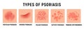 Psoriasis rash vector skin hand infection background. Psoriasis dermatitis eczema cartoon illustration Royalty Free Stock Photo