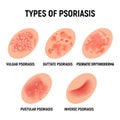 Psoriasis rash vector skin hand infection background. Psoriasis dermatitis eczema cartoon illustration Royalty Free Stock Photo