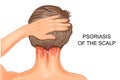 Psoriasis of the scalp Royalty Free Stock Photo