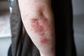 Psoriasis skin. Psoriasis is an autoimmune disease that affects the skin cause skin inflammation red and scaly. Eczema