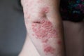 Psoriasis skin. Psoriasis is an autoimmune disease that affects the skin cause skin inflammation red and scaly. Eczema