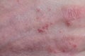 Psoriasis skin. Psoriasis is an autoimmune disease that affects the skin cause skin inflammation red and scaly. Macro