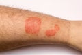 Psoriasis skin. Close-up of a rash and scaling on the patient`s