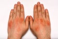 Psoriasis skin. Close-up of a rash and scaling on the patient`s