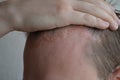 Psoriasis on the skin close-up, scalp, photos of dermatitis and eczema, skin problems, dermatology Royalty Free Stock Photo